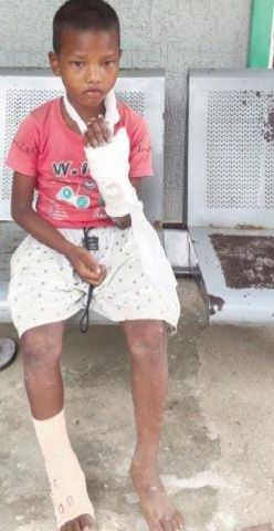 शिक्षिका ने छात्र को पीटकर तोड़े हाथ-पैर, मुख्यमंत्री ने लिया संज्ञान।